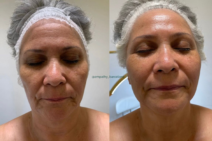 Tratamiento facial personalizado
